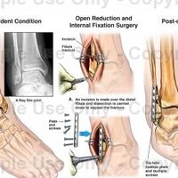 Belinda Fibula Nagie